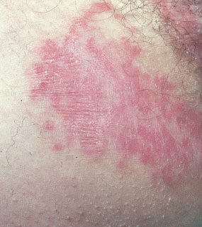 Psoriasis Etiology, Symptoms and Signs & Treatment │ Merck ...