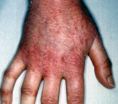 pictures of poison sumac rash. poison sumac rash on face.