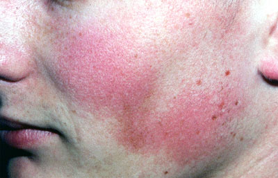 Topical steroids facial eczema
