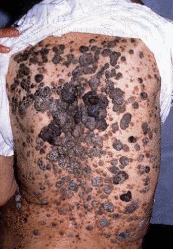 Form of seborrhoeic dermatitis face non-inflammatory seborrheic any way to